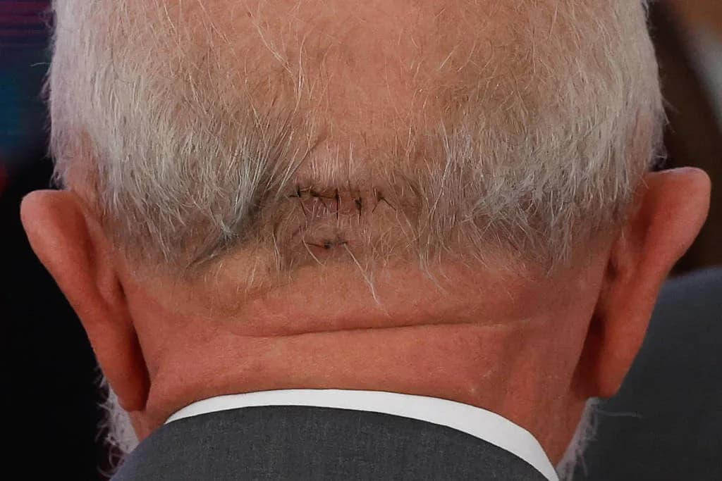 Médicos atualizam estado de saúde de Lula após cirurgia: “Estável, conversando e se alimentando”