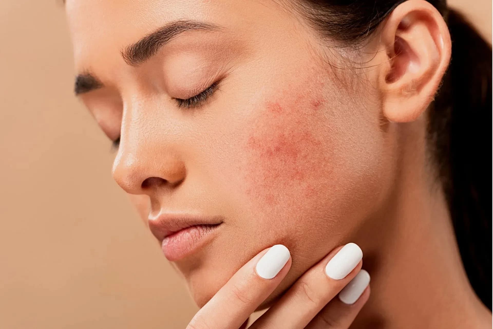 Você sabia que é possível tratar acne de graça pelo SUS? Saiba como funciona