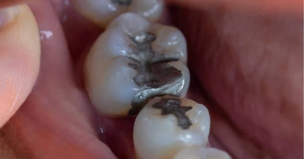 Brasil vai banir amálgama dentário até 2030 por risco ambiental ligado ao mercúrio