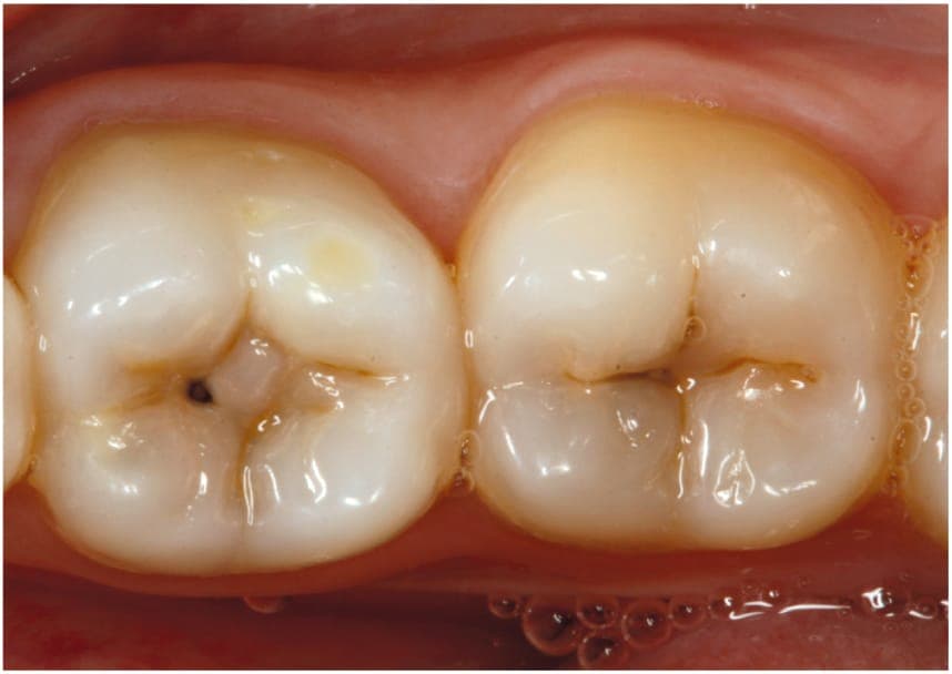Adiar ida ao dentista pode custar o dente e gerar problemas de saúde, alerta especialista