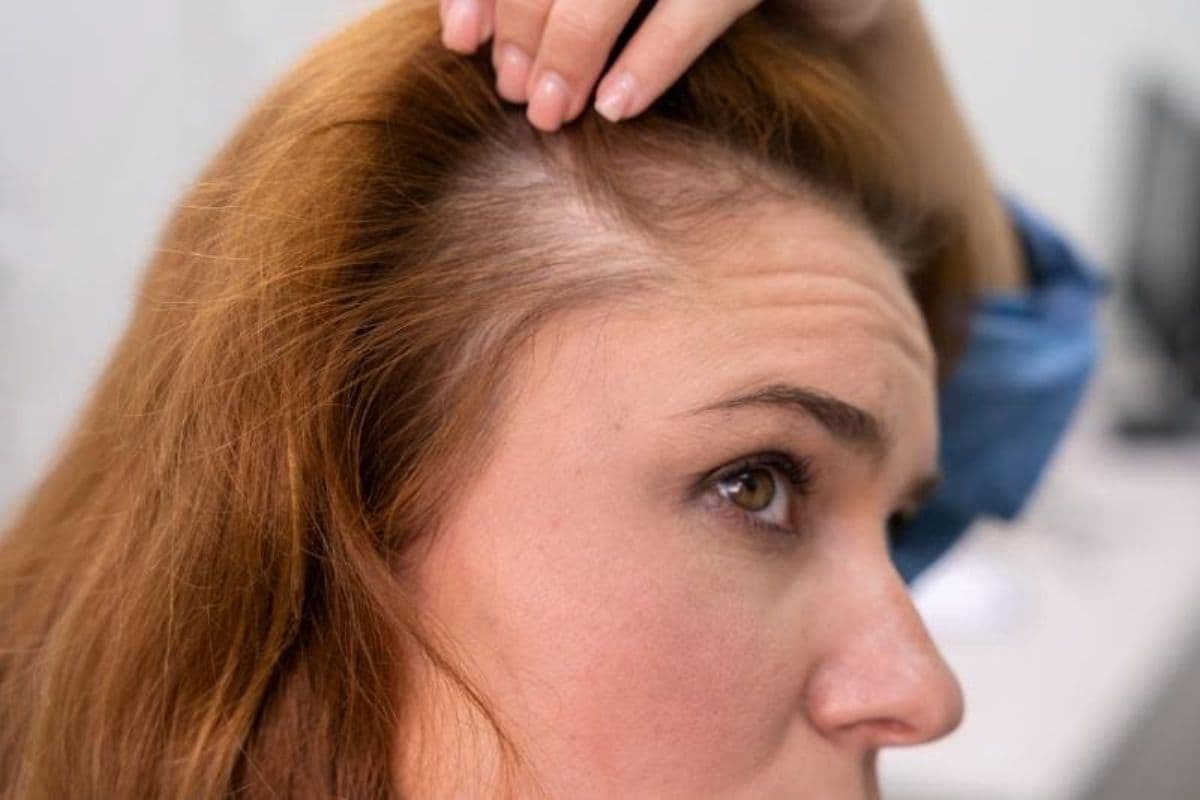 Calvície androgenética e alopecia por tração: como identificar, prevenir e tratar