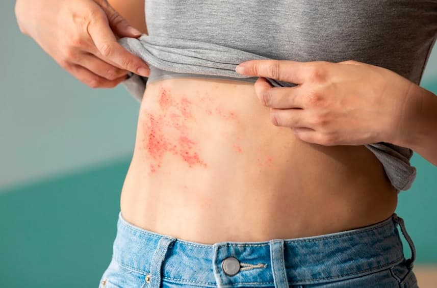 Herpes-zóster, o “cobreiro”, pode deixar sequelas por anos; entenda
