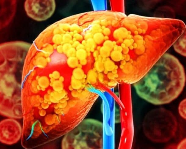 Novo remédio reduz gordura no fígado e mostra resultados promissores contra obesidade