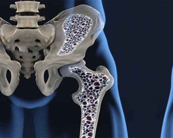 Menopausa pode aumentar risco de osteoporose e acelerar perda óssea