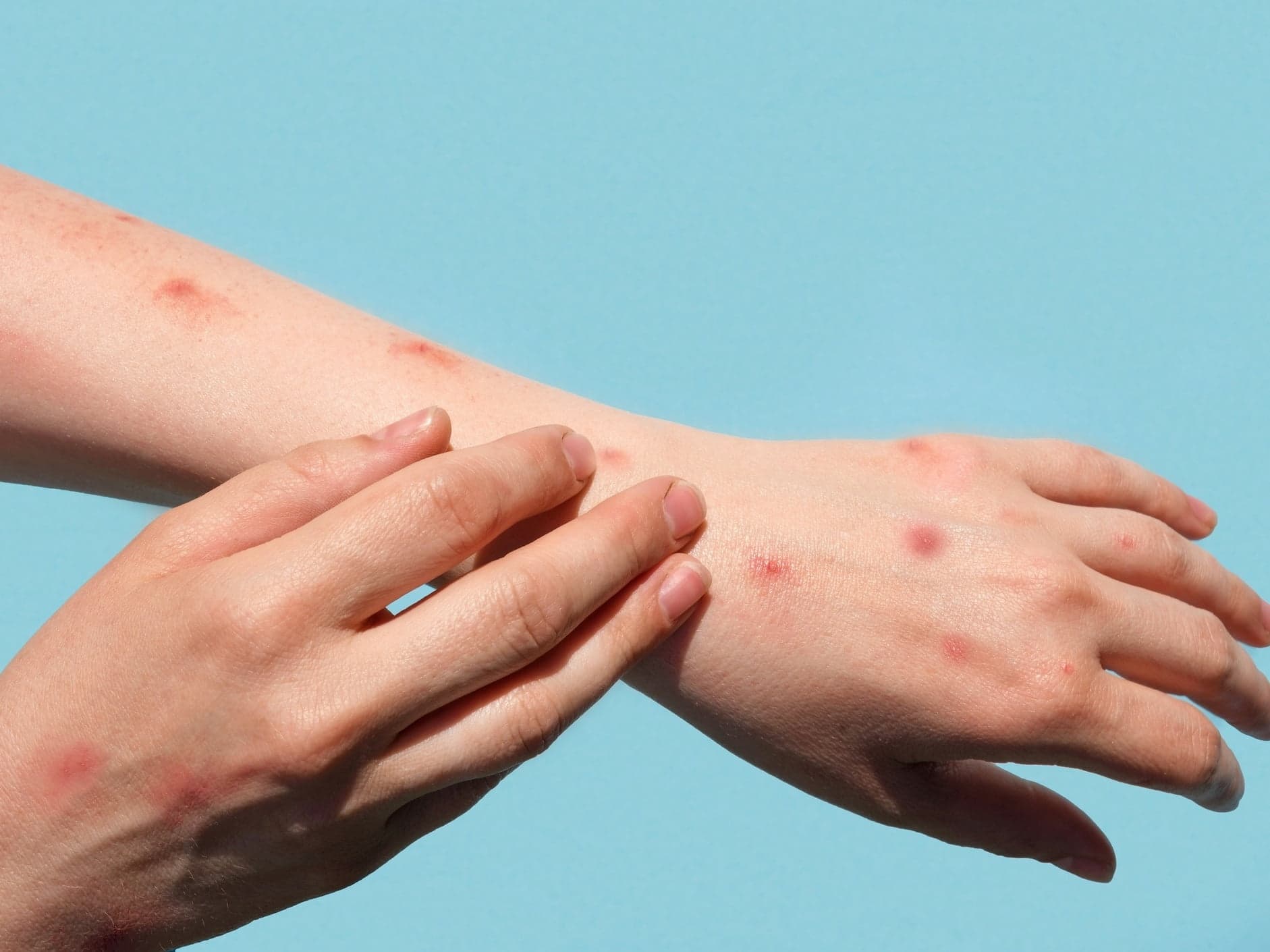 Amazonas confirma segundo caso de monkeypox