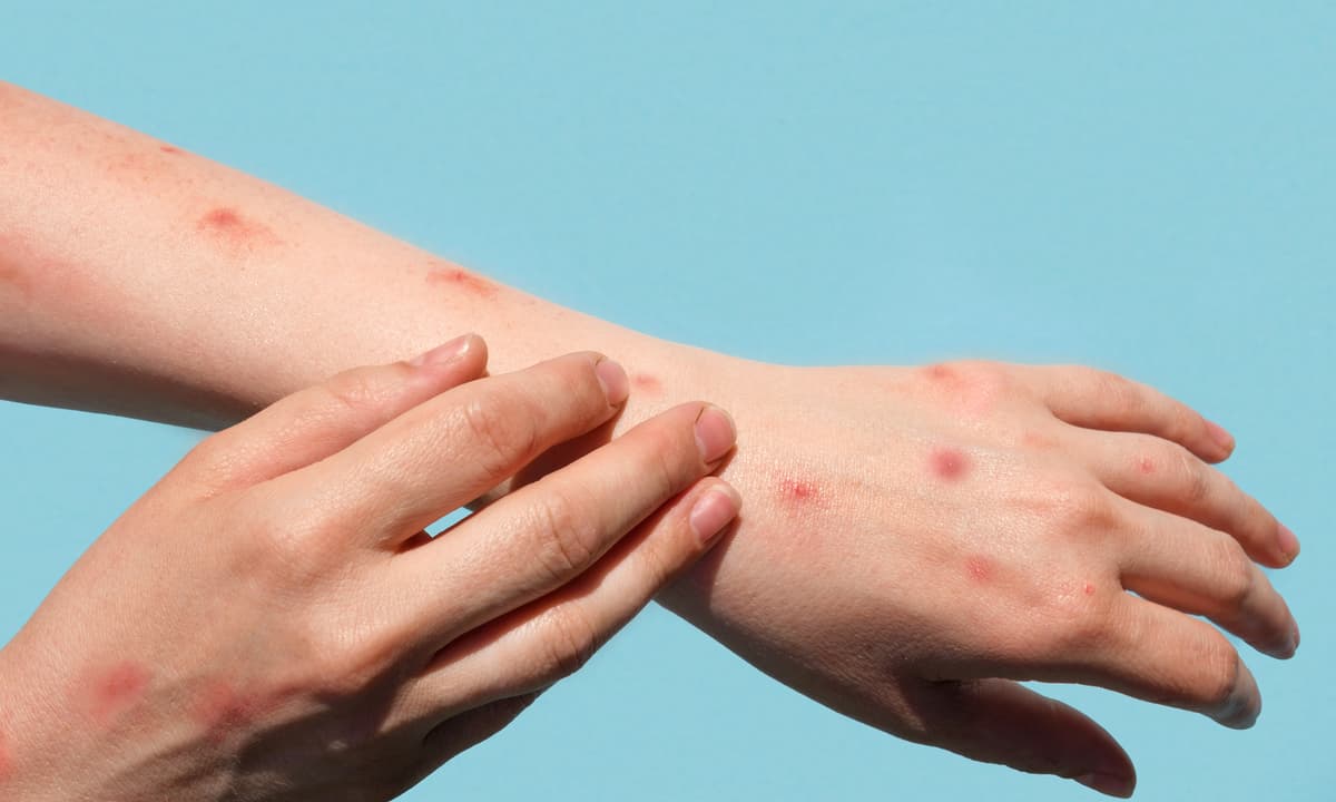 Casos de mpox aumentam em Manaus e autoridades reforçam alerta sobre prevenção e cuidados