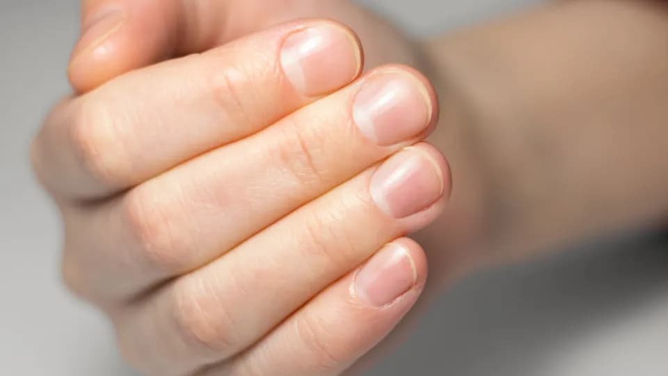 O que suas unhas revelam sobre sua saúde? confira alguns sinais