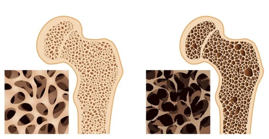 Osteoporose avança em ritmo acelerado e casos podem explodir até 2050, inclusive no Brasil